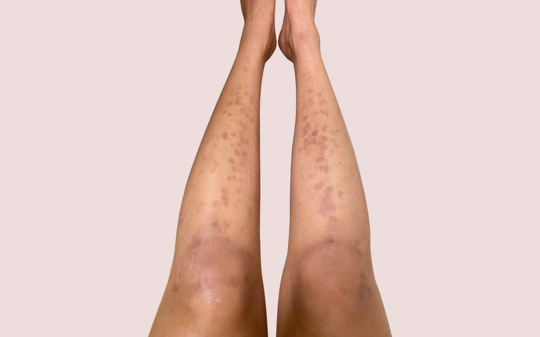 two legs with laser hair removal burns