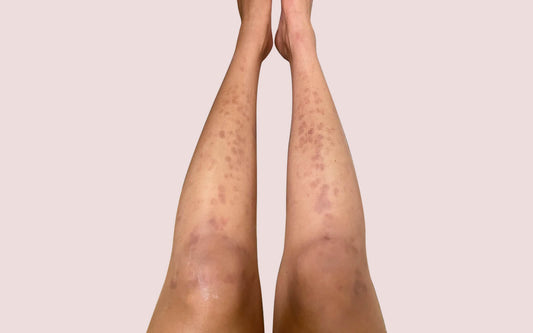 two legs with laser hair removal burns 